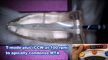 MTA obturation procedure in a 3D printed tooth replica with 812MT/812MTを用いたプラスチック根管のMTA根管充填