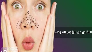 التخلص من الرؤوس السوداء من الأنف