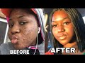 HOW I CLEARED MY ACNE SUPER FAST! ||  My skin journey || Ghanaian YouTuber || Alba botanica
