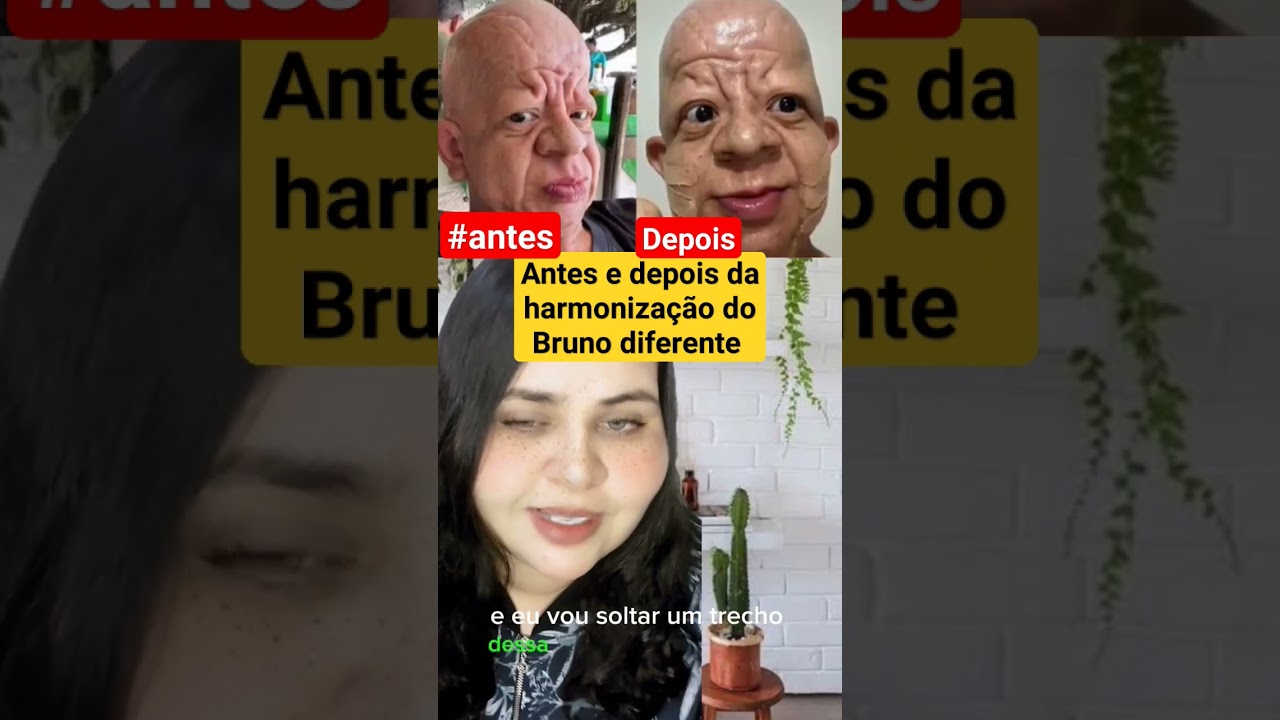 Bruno Diferente faz harmonização facial - Embed