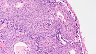Inverted Papilloma of Bladder - Pathology mini tutorial