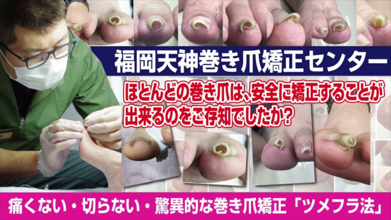 福岡市天神にある巻き爪矯正専門院 福岡天神巻き爪矯正センター Youtube 福岡市天神にある巻き爪矯正専門院 福岡天神巻き爪矯正センター Youtube