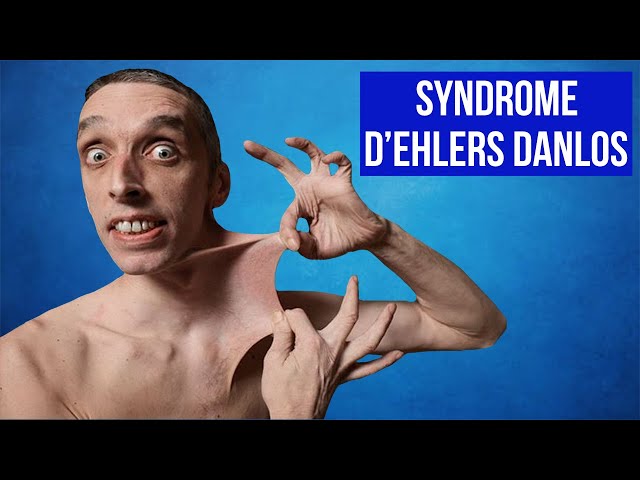 Syndrome d'EHLERS-DANLOS : Quelle rééducation ?