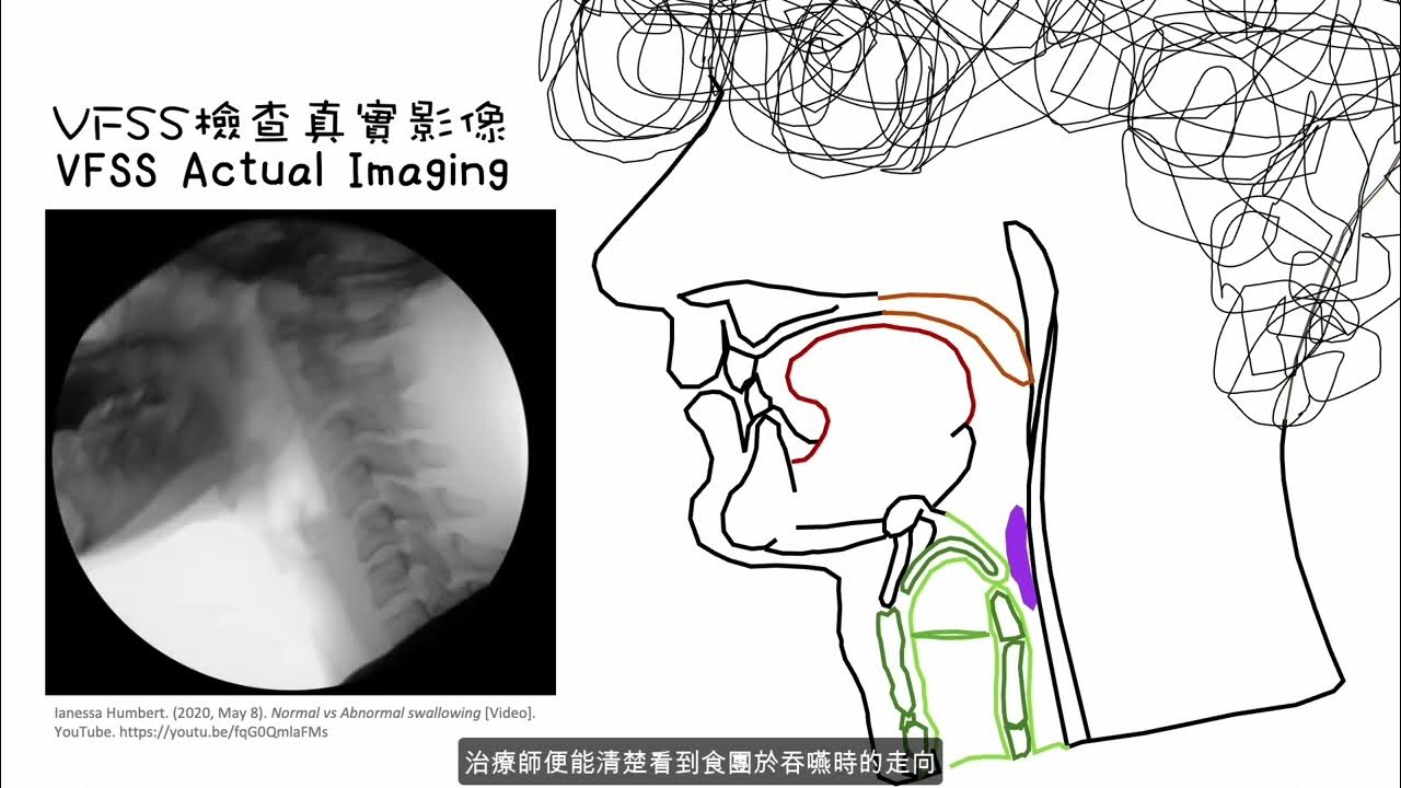 videofluoroscopic-swallowing-study-vfss-x-youtube