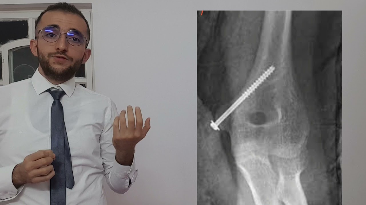 UL: medial epicondyle fracture l كسر عود اللقمه