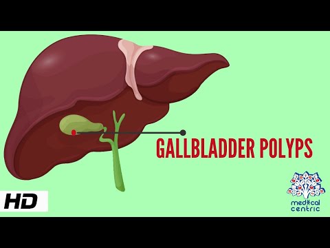 Video: Polyps In The Gallbladder: Symptoms, Treatment, Causes, Diagnosis