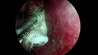 microdebrider endoscopic polyp surgery rt