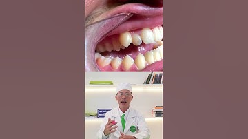 Niềng răng khớp cắn ngược 🦷 #shorts #niengrang #braces