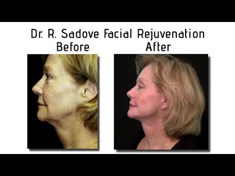 Before and after lateral view Panniculectomy - Sadove Cosmetic Surgery