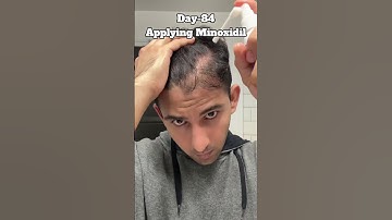 Day-85 Applying Minoxidil Till i Recover Hairline #hairloss #haircare #hairgrowth #minoxidil