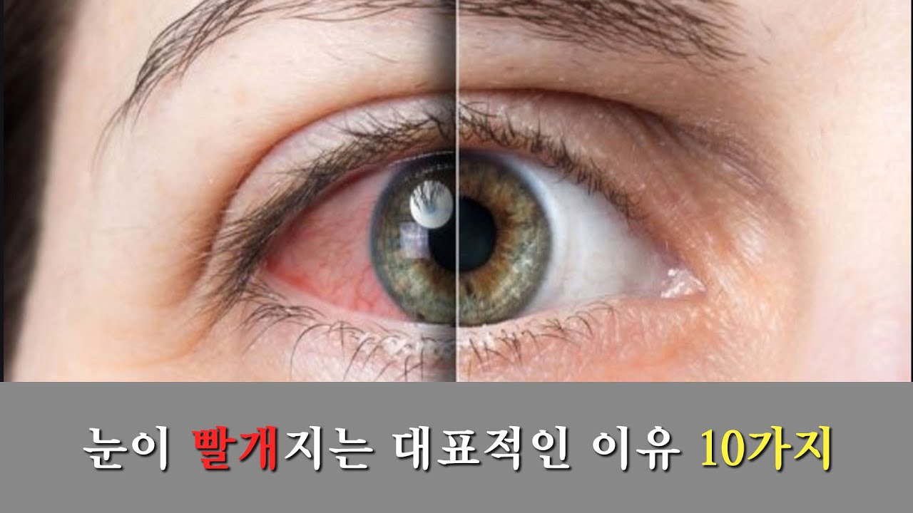 Update 안과: 눈이 빨개지는 대표적인 이유 10가지 (2번째)