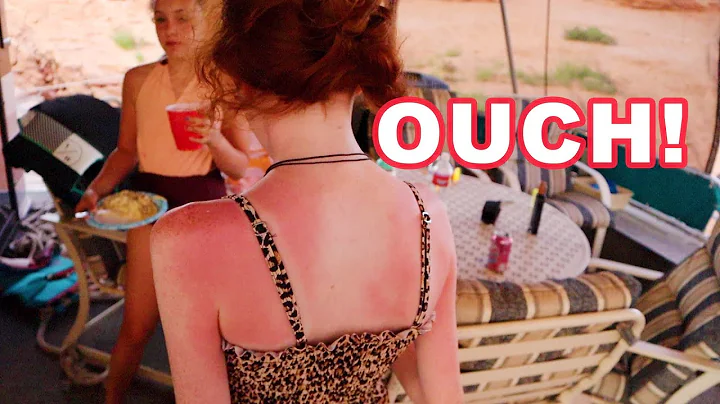 PAINFUL SUNBURN ON DAY 1 AT LAKE POWELL