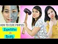 HOW To CURE Pimples/Acne - Expectations vs Reality | #Skincare #Routine #Anaysa