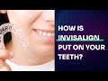 How is Invisalign put on your teeth? Step by Step Detailed Answer!