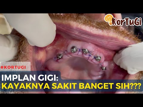 Video: Adakah penyangga implan menyakitkan?