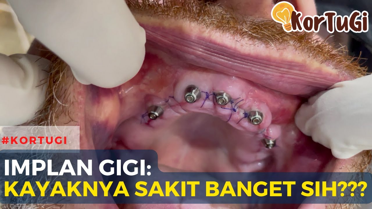 Implan Gigi SESAKIT APA WOI??? | KorTuGi