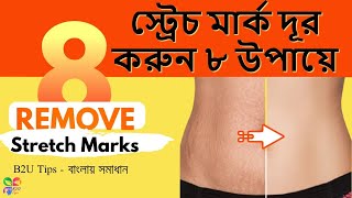 স্ট্রেচ মার্ক দূর করুন ৮ উপায়ে | How to remove stretchmarks | b2utips