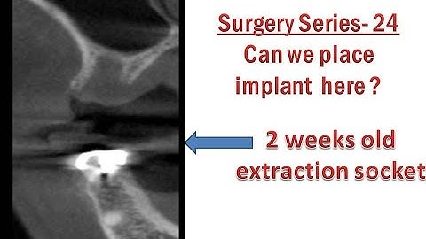 Using wide BCS implants for premolar extraction socket