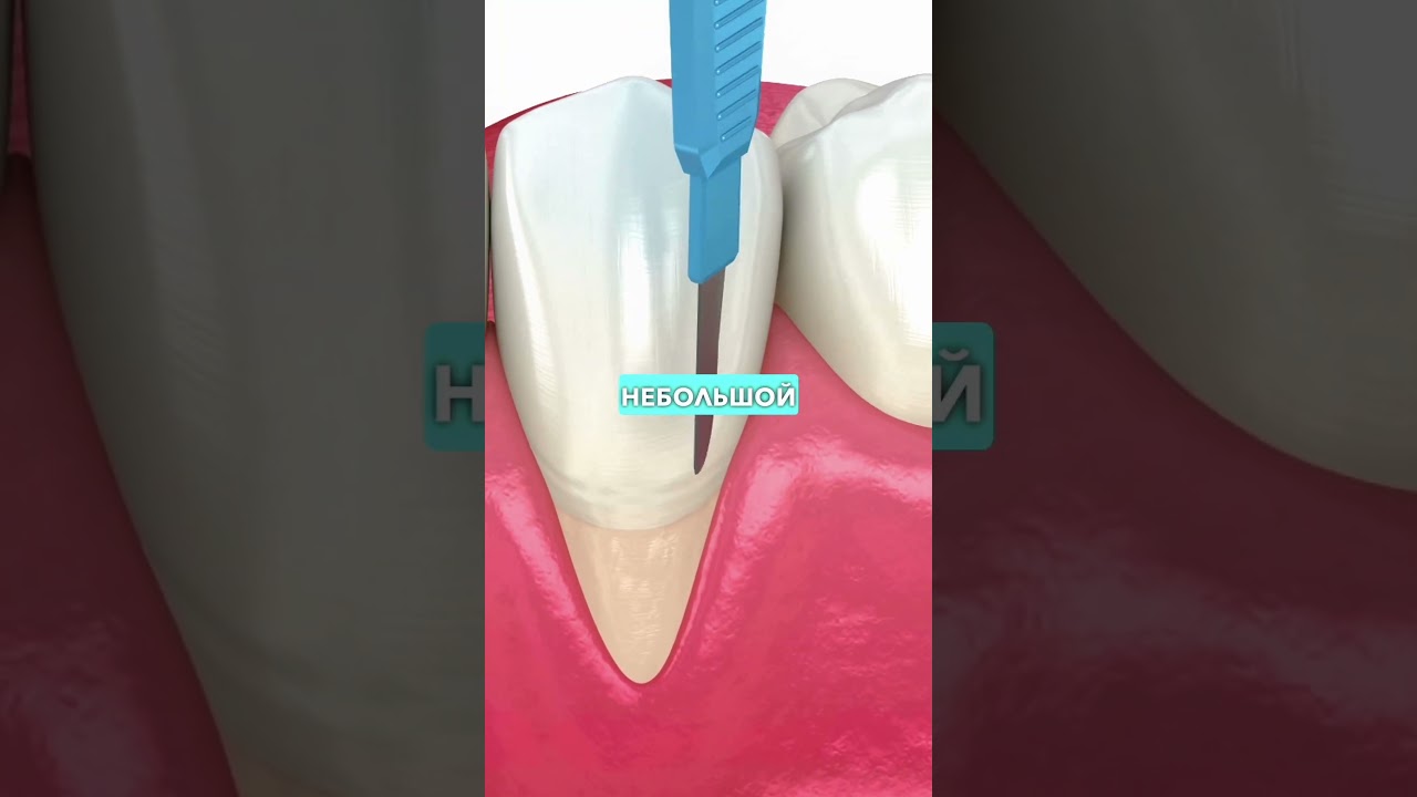 Дёсны Опустились 😖🦷 (что делать) ✨ #shorts #факты #опустилась #десна #рецессиядесны #интересно