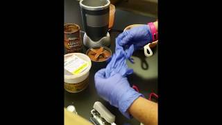 Positive Hemoccult Test
