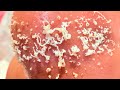 Full video Asmar removal black heads 