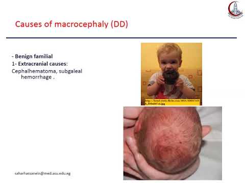 5. Macrocephaly
