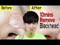 Korean tips to 'REMOVE Blackhead' in just 10 minutes!