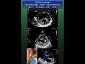 POCUS- cardiac /Parasternal short axis -mitral valve :midpapillary level