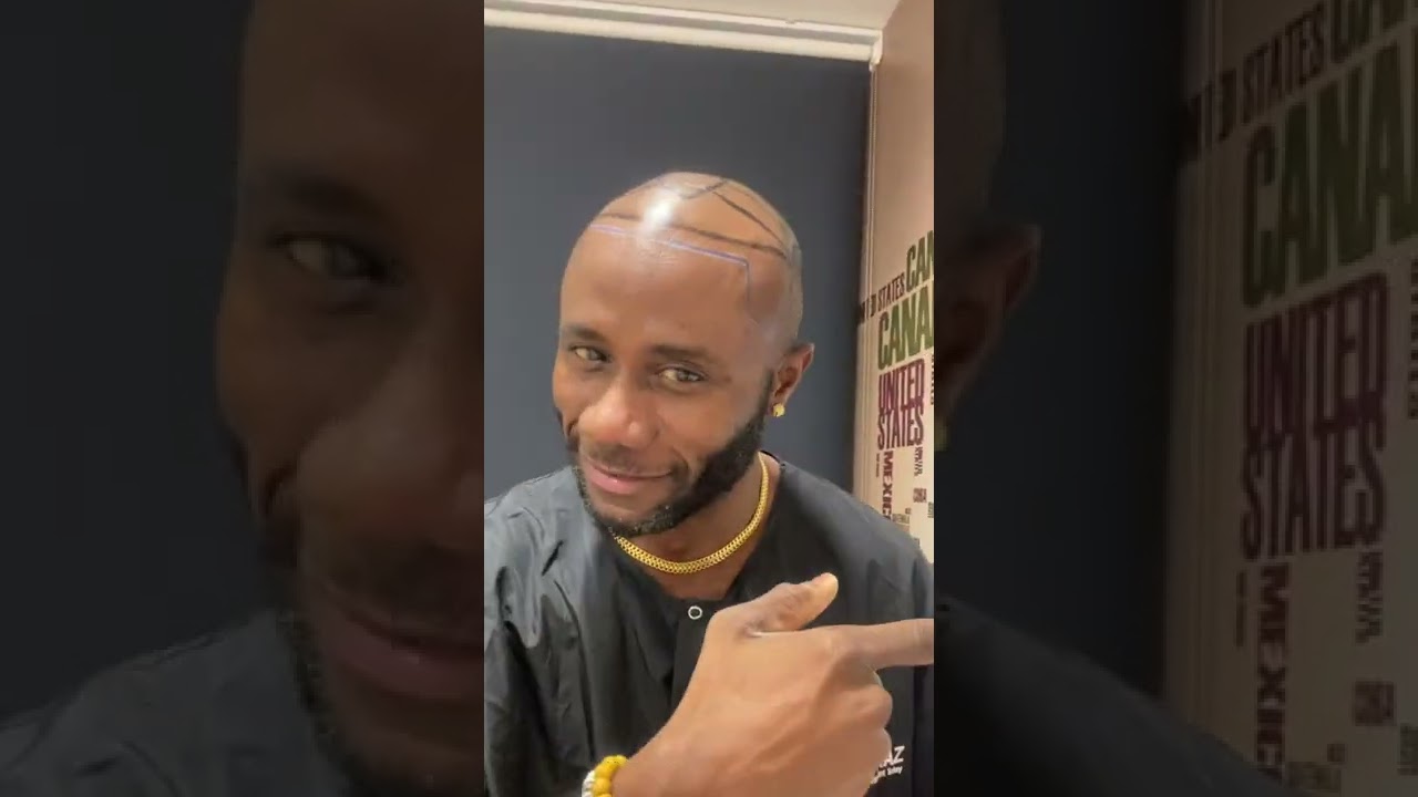 Mr Christopher - Hair Transplant review