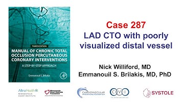 Case 287: Manual of CTO PCI - LAD CTO with poorly visualized distal vessel