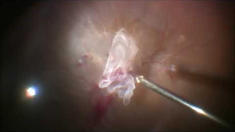 Tractional Retinal Detachment | Diabetic Retinopathy | PDR | Retinal Detachment | Dr Manish Nagpal