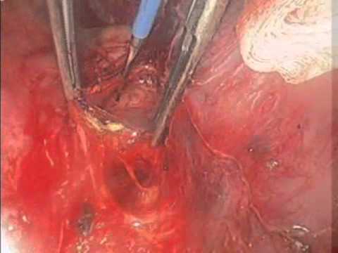 Subcarinal Dissection.wmv - YouTube