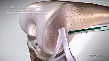 RIGIDLOOP Adjustable Cortical System - Surgical Technique Video