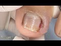 Grau 3 De Inflamação em Um Menino De 11 anos #satisfying #nails #usa
