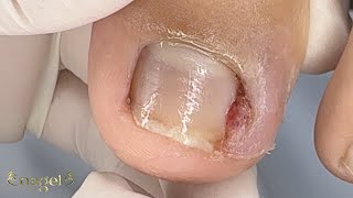 Grau 3 De Inflamação em Um Menino De 11 anos #satisfying #nails #usa
