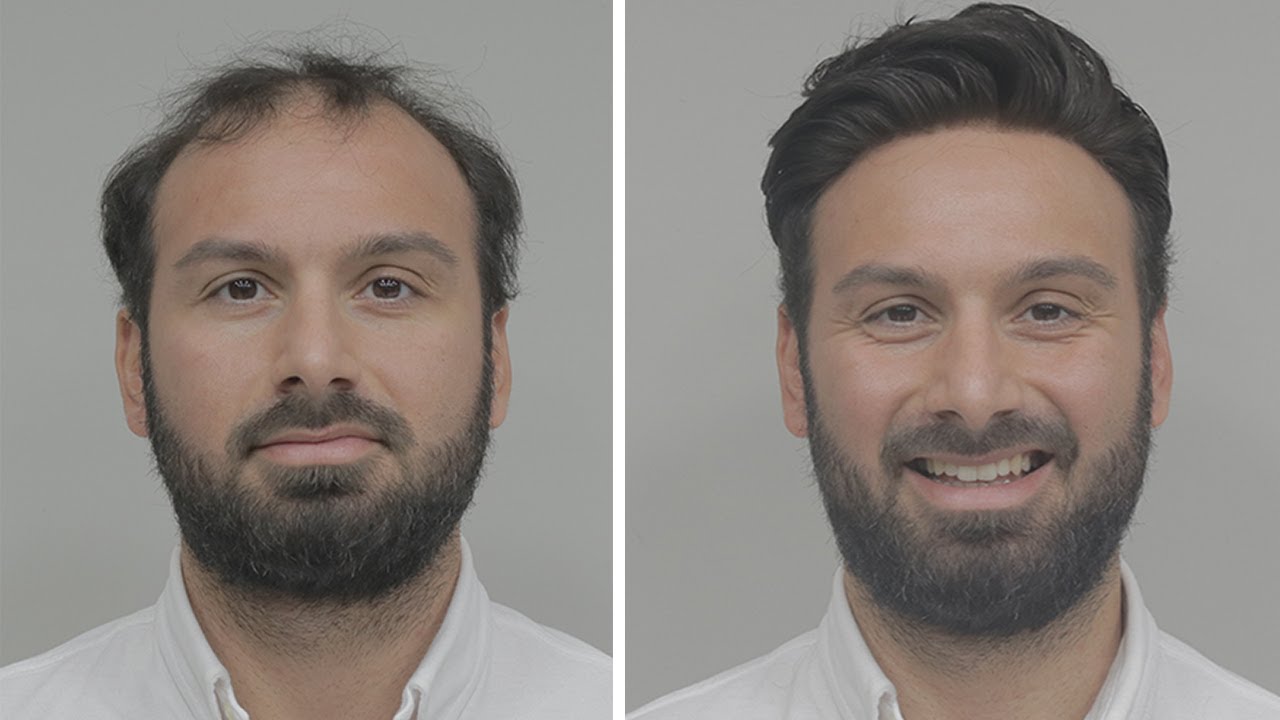PROTEZ SAÇ UYGULAMASI - Hair Replacement