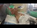 Vie scope intubation of a patient with spondyloarthritis with no neck movement