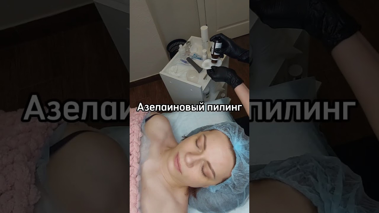 Азелаиновый пилинг. Против купероза, розацеа, акне, постакне, пигментации. #косметологспб #уход