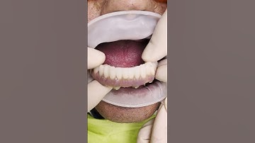 Implant Dentistry: Restoring Your Smile #shorts #short #dentist #dental #dsmile #implantdentistry