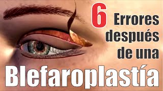 6 Common Mistakes Patients Make After Blepharoplasty 👁️ Eyelid Surgery ❤️ Dr. Alberto Calvo