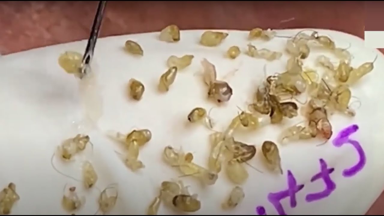 BLACKHEADS & ACNE TREATMENT ON THE FACE // Satisfying Relaxing Best