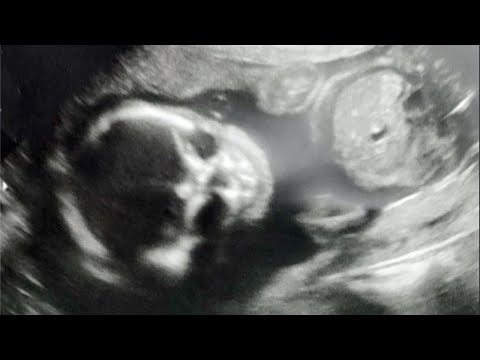 Mom Freaked Out by 'Skeletal' Ultrasound Photo