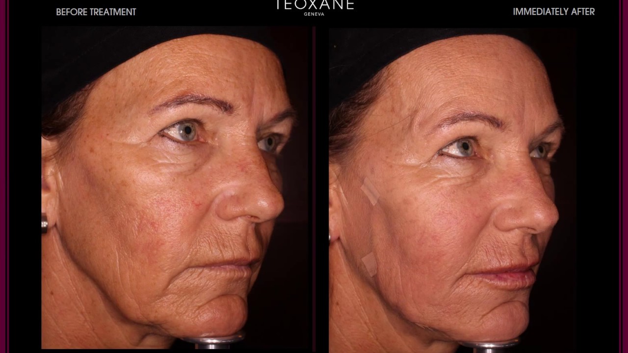 See the results of Dr Sebagh demonstrating threads & fillers, Teoxane Ways of Beauty - YouTube