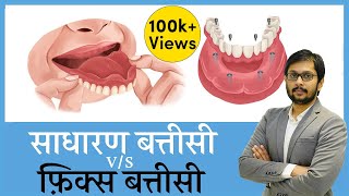 Smart Comparison of Removable Dentures v/s Fix Implant Dentures..all aspects covered!