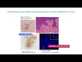 3 step algorithm for acral melanocytic lesions  dr toshiaki saida