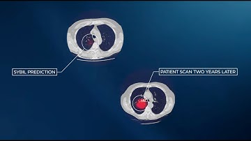 How AI predicts lung cancer risk 6 years in advance (2 min)