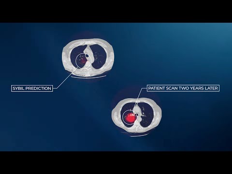 How AI predicts lung cancer risk 6 years in advance (2 min)
