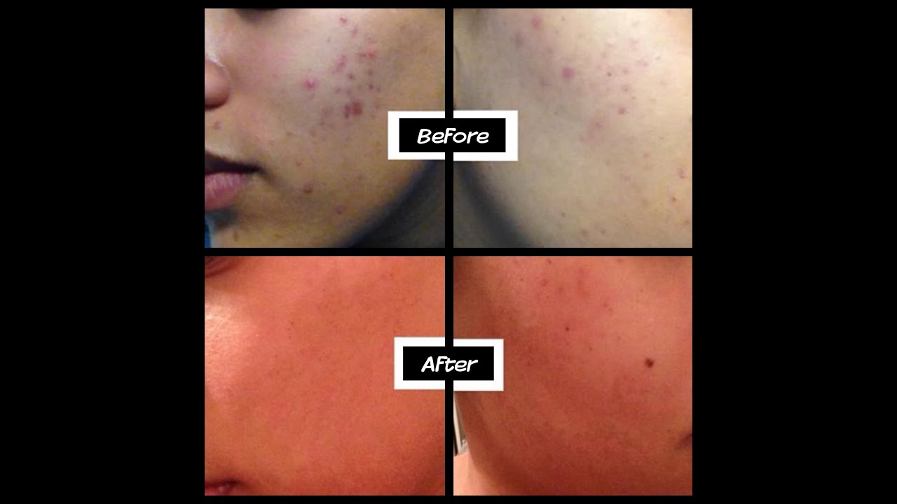 Skincare Series- Part I: How to get rid of acne & scars | Daytime ...