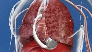 Your Health: Stanford's Dipanjan Banerjee, MD, Discusses Left Ventricular Assist Device (LVAD)