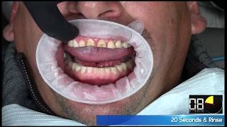 Complete Smile transformation ( STAGE 1)at Advanced Smiles Dentistry Tijuana